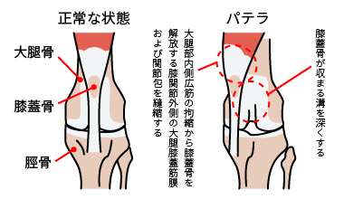 膝蓋骨脱臼(パテラ)